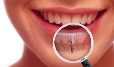 Implants for $2500 ( not including bone graft and sinus lifting)